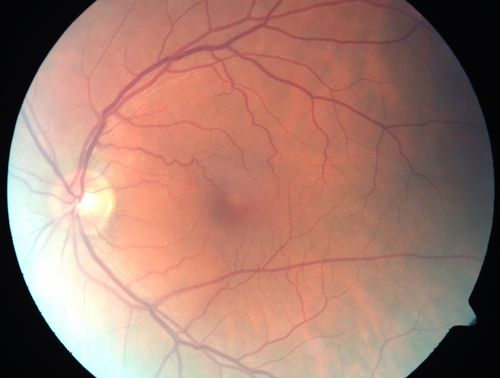 Serous Macular Detachment Both Eyes - Wet AMD vs. CSR - 62 Year Old Man - Color Photo
