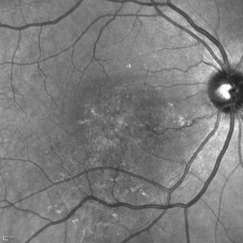 Serous Macular Detachment Both Eyes - Wet AMD vs. CSR - 62 Year Old Man - IR
