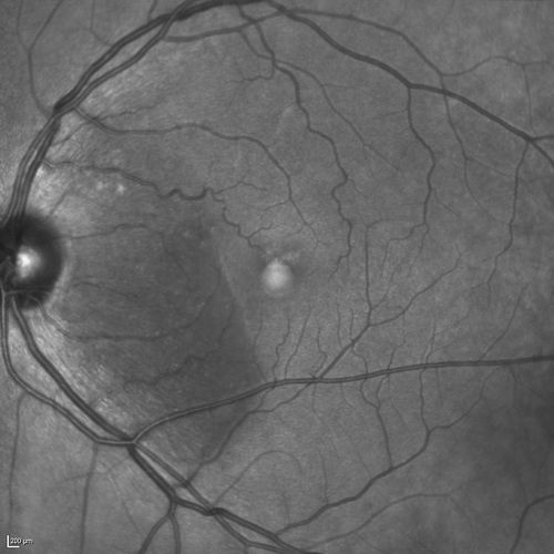 Serous Macular Detachment Both Eyes - Wet AMD vs. CSR - 62 Year Old Man - IR
