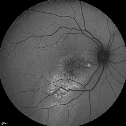 Serous Macular Detachment Both Eyes - Wet AMD vs. CSR - 62 Year Old Man - FAF
