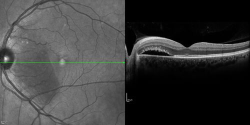 Serous Macular Detachment Both Eyes - Wet AMD vs. CSR - 62 Year Old Man - SD - OCT
