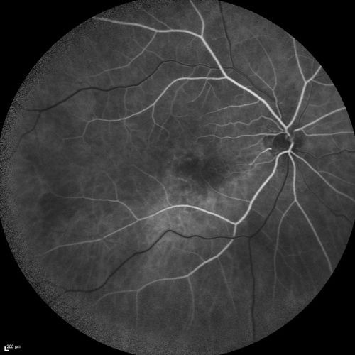 Serous Macular Detachment Both Eyes - Wet AMD vs. CSR - 62 Year Old Man - Fluorescein angiogram

