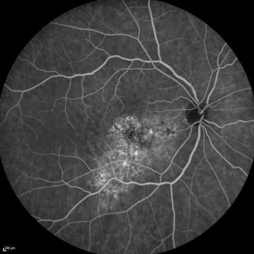 Serous Macular Detachment Both Eyes - Wet AMD vs. CSR - 62 Year Old Man - Fluorescein angiogram
