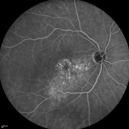Serous Macular Detachment Both Eyes - Wet AMD vs. CSR - 62 Year Old Man - Fluorescein angiogram
