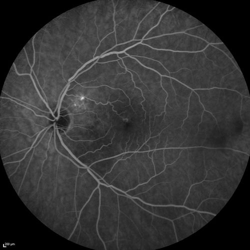 Serous Macular Detachment Both Eyes - Wet AMD vs. CSR - 62 Year Old Man - Fluorescein angiogram
