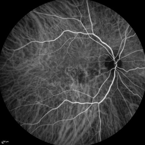 Serous Macular Detachment Both Eyes - Wet AMD vs. CSR - 62 Year Old Man ICG
