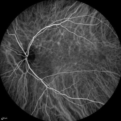 Serous Macular Detachment Both Eyes - Wet AMD vs. CSR - 62 Year Old Man ICG 
