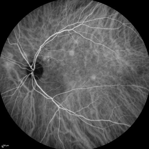 Serous Macular Detachment Both Eyes - Wet AMD vs. CSR - 62 Year Old Man ICG
