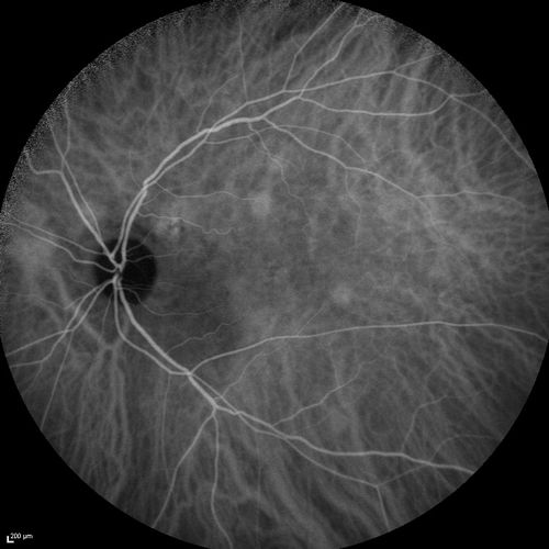 Serous Macular Detachment Both Eyes - Wet AMD vs. CSR - 62 Year Old Man ICG
