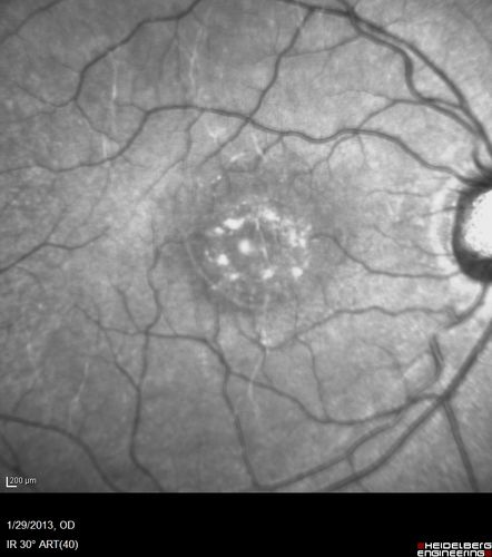 Central Serous Retinopathy 25 year old professional baseball player - Atypical - Choroidal Hypo-perfusion?
