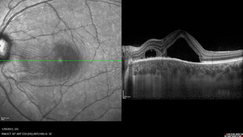 Central Serous Retinopathy 25 year old professional baseball player - Atypical - Choroidal Hypo-perfusion?
