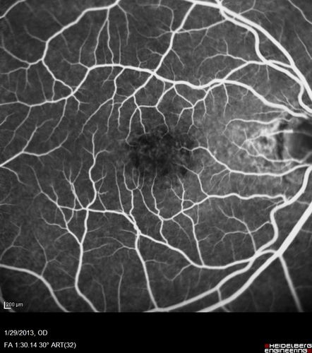 Central Serous Retinopathy 25 year old professional baseball player - Atypical - Choroidal Hypo-perfusion?

