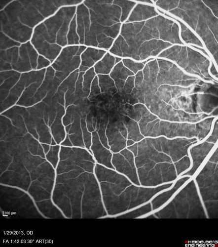 Central Serous Retinopathy 25 year old professional baseball player - Atypical - Choroidal Hypo-perfusion?
