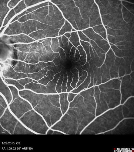 Central Serous Retinopathy 25 year old professional baseball player - Atypical - Choroidal Hypo-perfusion?
