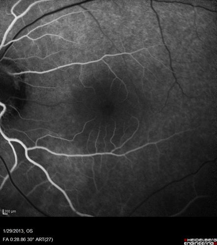 Central Serous Retinopathy 25 year old professional baseball player - Atypical - Choroidal Hypo-perfusion?
