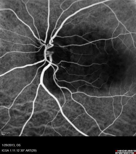 Central Serous Retinopathy 25 year old professional baseball player - Atypical - Choroidal Hypo-perfusion?

