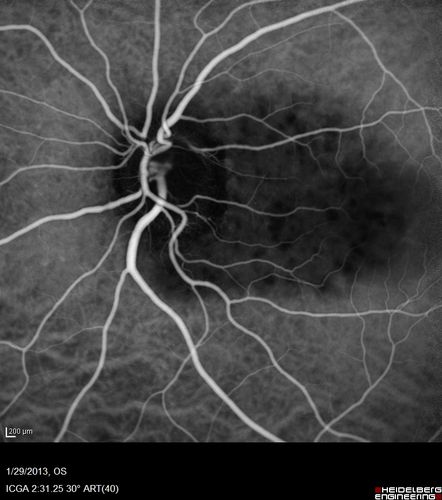Central Serous Retinopathy 25 year old professional baseball player - Atypical - Choroidal Hypo-perfusion?
