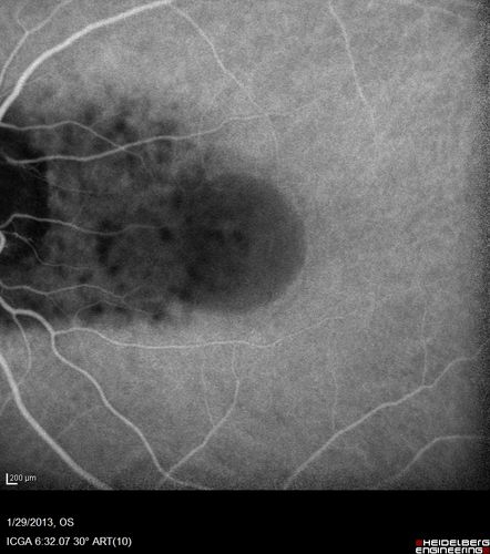 Central Serous Retinopathy 25 year old professional baseball player - Atypical - Choroidal Hypo-perfusion?
