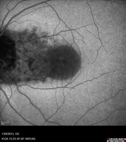 Central Serous Retinopathy 25 year old professional baseball player - Atypical - Choroidal Hypo-perfusion?
