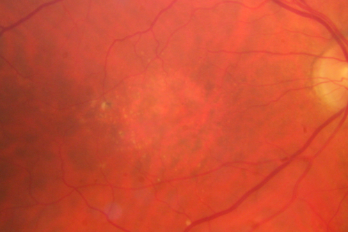 Cuticular Drusen (Basal Laminar Drusen) and Bilateral Chronic Subfoveal Fluid (Serous Retinal Detachment) unresponsive to monthly Avastin 
66-year-old man with bilateral subfoveal fluid unresponsive to one year of monthly avastin therapy.
OD 20/160,  Pinhole 20/80.   OS 20/63,  Pinhole 20/50.  OCT scan shows subretinal fluid with normal choroidal thickness.  Fluorescein angiogram shows cuticular/basal laminar drusen.  ICG shows no foci of choriocapillaris leakage.

