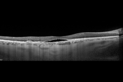 Cuticular Drusen (Basal Laminar Drusen) and Bilateral Chronic Subfoveal Fluid (Serous Retinal Detachment) unresponsive to monthly Avastin OCT OD EDI
66-year-old man with bilateral subfoveal fluid unresponsive to one year of monthly avastin therapy.
OD 20/160,  Pinhole 20/80.   OS 20/63,  Pinhole 20/50.  OCT scan shows subretinal fluid with normal choroidal thickness.  Fluorescein angiogram shows cuticular/basal laminar drusen.  ICG shows no foci of choriocapillaris leakage.

