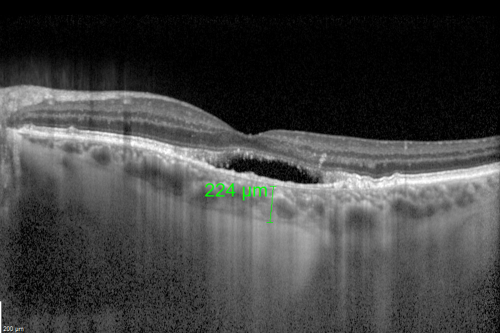Cuticular Drusen (Basal Laminar Drusen) and Bilateral Chronic Subfoveal Fluid (Serous Retinal Detachment) unresponsive to monthly Avastin OCT OS EDI
66-year-old man with bilateral subfoveal fluid unresponsive to one year of monthly avastin therapy.
OD 20/160,  Pinhole 20/80.   OS 20/63,  Pinhole 20/50.  OCT scan shows subretinal fluid with normal choroidal thickness.  Fluorescein angiogram shows cuticular/basal laminar drusen.  ICG shows no foci of choriocapillaris leakage.

