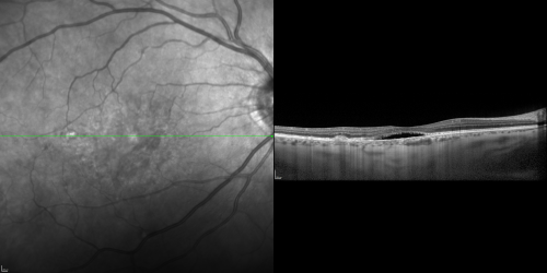 Cuticular Drusen (Basal Laminar Drusen) and Bilateral Chronic Subfoveal Fluid (Serous Retinal Detachment) unresponsive to monthly Avastin OCT OD
66-year-old man with bilateral subfoveal fluid unresponsive to one year of monthly avastin therapy.
OD 20/160,  Pinhole 20/80.   OS 20/63,  Pinhole 20/50.  OCT scan shows subretinal fluid with normal choroidal thickness.  Fluorescein angiogram shows cuticular/basal laminar drusen.  ICG shows no foci of choriocapillaris leakage.

