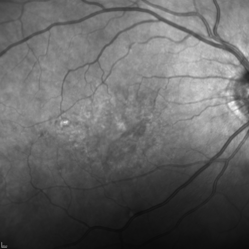 Cuticular Drusen (Basal Laminar Drusen) and Bilateral Chronic Subfoveal Fluid (Serous Retinal Detachment) unresponsive to monthly Avastin Infrared OD
66-year-old man with bilateral subfoveal fluid unresponsive to one year of monthly avastin therapy.
OD 20/160,  Pinhole 20/80.   OS 20/63,  Pinhole 20/50.  OCT scan shows subretinal fluid with normal choroidal thickness.  Fluorescein angiogram shows cuticular/basal laminar drusen.  ICG shows no foci of choriocapillaris leakage.

