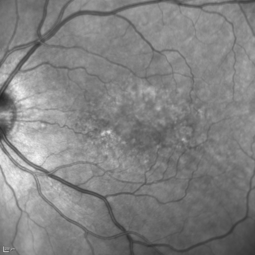 Cuticular Drusen (Basal Laminar Drusen) and Bilateral Chronic Subfoveal Fluid (Serous Retinal Detachment) unresponsive to monthly Avastin - Infrared OS
66-year-old man with bilateral subfoveal fluid unresponsive to one year of monthly avastin therapy.
OD 20/160,  Pinhole 20/80.   OS 20/63,  Pinhole 20/50.  OCT scan shows subretinal fluid with normal choroidal thickness.  Fluorescein angiogram shows cuticular/basal laminar drusen.  ICG shows no foci of choriocapillaris leakage.

