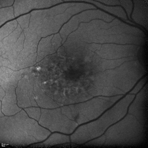 Cuticular Drusen (Basal Laminar Drusen) and Bilateral Chronic Subfoveal Fluid (Serous Retinal Detachment) unresponsive to monthly Avastin - Fundus Autofluorescence OD
66-year-old man with bilateral subfoveal fluid unresponsive to one year of monthly avastin therapy.
OD 20/160,  Pinhole 20/80.   OS 20/63,  Pinhole 20/50.  OCT scan shows subretinal fluid with normal choroidal thickness.  Fluorescein angiogram shows cuticular/basal laminar drusen.  ICG shows no foci of choriocapillaris leakage.

