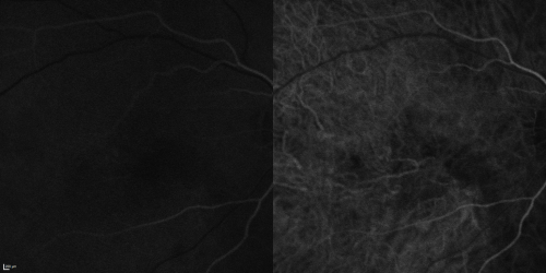 Cuticular Drusen (Basal Laminar Drusen) and Bilateral Chronic Subfoveal Fluid (Serous Retinal Detachment) unresponsive to monthly Avastin  - Fill ICG FA OD
66-year-old man with bilateral subfoveal fluid unresponsive to one year of monthly avastin therapy.
OD 20/160,  Pinhole 20/80.   OS 20/63,  Pinhole 20/50.  OCT scan shows subretinal fluid with normal choroidal thickness.  Fluorescein angiogram shows cuticular/basal laminar drusen.  ICG shows no foci of choriocapillaris leakage.

