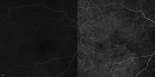Cuticular Drusen (Basal Laminar Drusen) and Bilateral Chronic Subfoveal Fluid (Serous Retinal Detachment) unresponsive to monthly Avastin  - Fill ICG FA OD
66-year-old man with bilateral subfoveal fluid unresponsive to one year of monthly avastin therapy.
OD 20/160,  Pinhole 20/80.   OS 20/63,  Pinhole 20/50.  OCT scan shows subretinal fluid with normal choroidal thickness.  Fluorescein angiogram shows cuticular/basal laminar drusen.  ICG shows no foci of choriocapillaris leakage.

