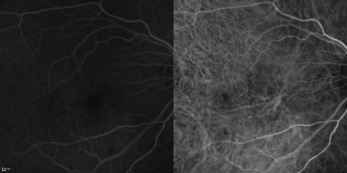 Cuticular Drusen (Basal Laminar Drusen) and Bilateral Chronic Subfoveal Fluid (Serous Retinal Detachment) unresponsive to monthly Avastin  - Fill ICG FA OD
66-year-old man with bilateral subfoveal fluid unresponsive to one year of monthly avastin therapy.
OD 20/160,  Pinhole 20/80.   OS 20/63,  Pinhole 20/50.  OCT scan shows subretinal fluid with normal choroidal thickness.  Fluorescein angiogram shows cuticular/basal laminar drusen.  ICG shows no foci of choriocapillaris leakage.

