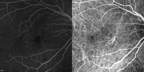 Cuticular Drusen (Basal Laminar Drusen) and Bilateral Chronic Subfoveal Fluid (Serous Retinal Detachment) unresponsive to monthly Avastin  - Fill ICG FA OD
66-year-old man with bilateral subfoveal fluid unresponsive to one year of monthly avastin therapy.
OD 20/160,  Pinhole 20/80.   OS 20/63,  Pinhole 20/50.  OCT scan shows subretinal fluid with normal choroidal thickness.  Fluorescein angiogram shows cuticular/basal laminar drusen.  ICG shows no foci of choriocapillaris leakage.


