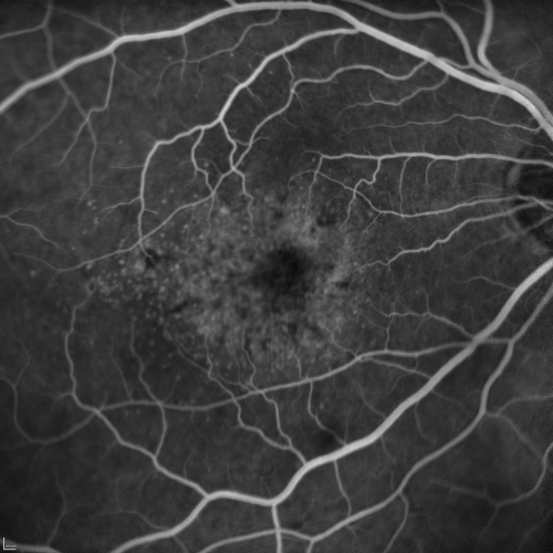 Cuticular Drusen (Basal Laminar Drusen) and Bilateral Chronic Subfoveal Fluid (Serous Retinal Detachment) unresponsive to monthly Avastin Early FA OD
66-year-old man with bilateral subfoveal fluid unresponsive to one year of monthly avastin therapy.
OD 20/160,  Pinhole 20/80.   OS 20/63,  Pinhole 20/50.  OCT scan shows subretinal fluid with normal choroidal thickness.  Fluorescein angiogram shows cuticular/basal laminar drusen.  ICG shows no foci of choriocapillaris leakage.

