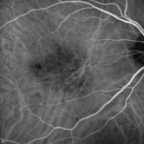 Cuticular Drusen (Basal Laminar Drusen) and Bilateral Chronic Subfoveal Fluid (Serous Retinal Detachment) unresponsive to monthly Avastin Very Early ICG OD
66-year-old man with bilateral subfoveal fluid unresponsive to one year of monthly avastin therapy.
OD 20/160,  Pinhole 20/80.   OS 20/63,  Pinhole 20/50.  OCT scan shows subretinal fluid with normal choroidal thickness.  Fluorescein angiogram shows cuticular/basal laminar drusen.  ICG shows no foci of choriocapillaris leakage.

