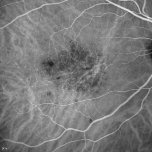 Cuticular Drusen (Basal Laminar Drusen) and Bilateral Chronic Subfoveal Fluid (Serous Retinal Detachment) unresponsive to monthly Avastin Early ICG OD
66-year-old man with bilateral subfoveal fluid unresponsive to one year of monthly avastin therapy.
OD 20/160,  Pinhole 20/80.   OS 20/63,  Pinhole 20/50.  OCT scan shows subretinal fluid with normal choroidal thickness.  Fluorescein angiogram shows cuticular/basal laminar drusen.  ICG shows no foci of choriocapillaris leakage.

