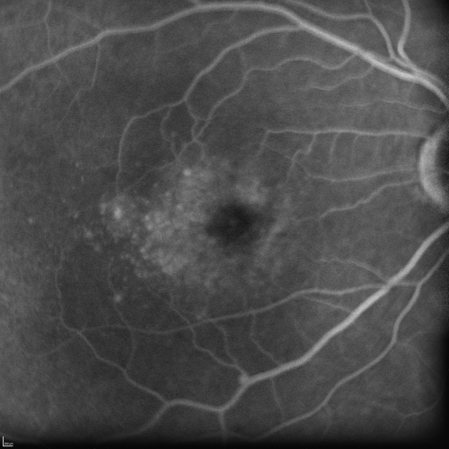 Cuticular Drusen (Basal Laminar Drusen) and Bilateral Chronic Subfoveal Fluid (Serous Retinal Detachment) unresponsive to monthly Avastin Late FA OD
66-year-old man with bilateral subfoveal fluid unresponsive to one year of monthly avastin therapy.
OD 20/160,  Pinhole 20/80.   OS 20/63,  Pinhole 20/50.  OCT scan shows subretinal fluid with normal choroidal thickness.  Fluorescein angiogram shows cuticular/basal laminar drusen.  ICG shows no foci of choriocapillaris leakage.

