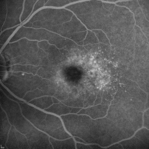 Cuticular Drusen (Basal Laminar Drusen) and Bilateral Chronic Subfoveal Fluid (Serous Retinal Detachment) unresponsive to monthly Avastin - Late FA OS
66-year-old man with bilateral subfoveal fluid unresponsive to one year of monthly avastin therapy.
OD 20/160,  Pinhole 20/80.   OS 20/63,  Pinhole 20/50.  OCT scan shows subretinal fluid with normal choroidal thickness.  Fluorescein angiogram shows cuticular/basal laminar drusen.  ICG shows no foci of choriocapillaris leakage.

