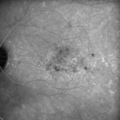 Cuticular Drusen (Basal Laminar Drusen) and Bilateral Chronic Subfoveal Fluid (Serous Retinal Detachment) unresponsive to monthly Avastin - ICG OS
66-year-old man with bilateral subfoveal fluid unresponsive to one year of monthly avastin therapy.
OD 20/160,  Pinhole 20/80.   OS 20/63,  Pinhole 20/50.  OCT scan shows subretinal fluid with normal choroidal thickness.  Fluorescein angiogram shows cuticular/basal laminar drusen.  ICG shows no foci of choriocapillaris leakage.

