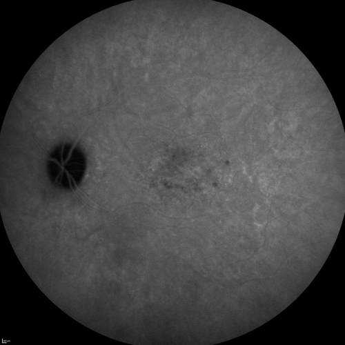 Cuticular Drusen (Basal Laminar Drusen) and Bilateral Chronic Subfoveal Fluid (Serous Retinal Detachment) unresponsive to monthly Avastin - 15 minute ICG Angiogram Left Eye
66-year-old man with bilateral subfoveal fluid unresponsive to one year of monthly avastin therapy.
OD 20/160,  Pinhole 20/80.   OS 20/63,  Pinhole 20/50.  OCT scan shows subretinal fluid with normal choroidal thickness.  Fluorescein angiogram shows cuticular/basal laminar drusen.  ICG shows no foci of choriocapillaris leakage.

