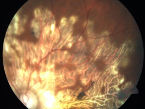 Serpiginouse Choroiditis (Chorioretinitis) - Acute Right Eye - Old Left Eye VA 20/25 OD , 20/50 OS
63-year-old woman has serpiginous choroiditis (date - March 2011).  The right eye has not been previously involved, and then she noticed new onset floaters in the right eye for the last two weeks.  Her vision in the right eye is hazy because of that.

VISUAL ACUITY:  Vision OD is 20/25, OS is 20/50
