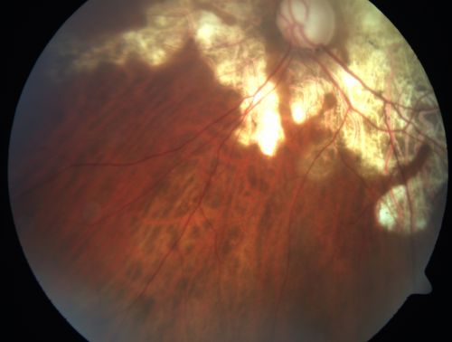 Serpiginouse Choroiditis (Chorioretinitis) - Acute Right Eye - Old Left Eye VA 20/25 OD , 20/50 OS
63-year-old woman has serpiginous choroiditis (date - March 2011).  The right eye has not been previously involved, and then she noticed new onset floaters in the right eye for the last two weeks.  Her vision in the right eye is hazy because of that.

VISUAL ACUITY:  Vision OD is 20/25, OS is 20/50

