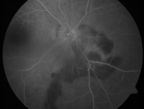 Serpiginouse Choroiditis (Chorioretinitis) - Acute Right Eye - Old Left Eye VA 20/25 OD , 20/50 OS
63-year-old woman has serpiginous choroiditis (date - March 2011).  The right eye has not been previously involved, and then she noticed new onset floaters in the right eye for the last two weeks.  Her vision in the right eye is hazy because of that.

VISUAL ACUITY:  Vision OD is 20/25, OS is 20/50
