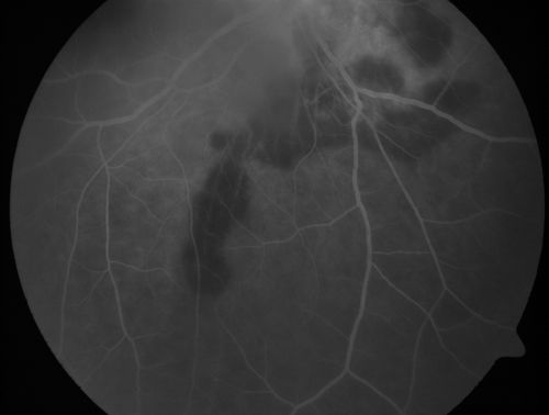 Serpiginouse Choroiditis (Chorioretinitis) - Acute Right Eye - Old Left Eye VA 20/25 OD , 20/50 OS
63-year-old woman has serpiginous choroiditis (date - March 2011).  The right eye has not been previously involved, and then she noticed new onset floaters in the right eye for the last two weeks.  Her vision in the right eye is hazy because of that.

VISUAL ACUITY:  Vision OD is 20/25, OS is 20/50
