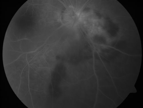 Serpiginouse Choroiditis (Chorioretinitis) - Acute Right Eye - Old Left Eye VA 20/25 OD , 20/50 OS
63-year-old woman has serpiginous choroiditis (date - March 2011).  The right eye has not been previously involved, and then she noticed new onset floaters in the right eye for the last two weeks.  Her vision in the right eye is hazy because of that.

VISUAL ACUITY:  Vision OD is 20/25, OS is 20/50
