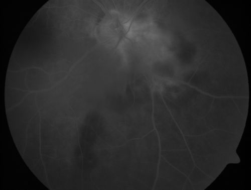 Serpiginouse Choroiditis (Chorioretinitis) - Acute Right Eye - Old Left Eye VA 20/25 OD , 20/50 OS
63-year-old woman has serpiginous choroiditis (date - March 2011).  The right eye has not been previously involved, and then she noticed new onset floaters in the right eye for the last two weeks.  Her vision in the right eye is hazy because of that.

VISUAL ACUITY:  Vision OD is 20/25, OS is 20/50
