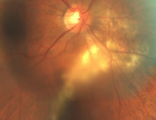 Serpiginouse Choroiditis (Chorioretinitis) - Acute Right Eye - Old Left Eye VA 20/25 OD , 20/50 OS - 1 Week After Intravitreal Kenalog OD
63-year-old woman has serpiginous choroiditis  1 week after intravitreal kenalog treatment
