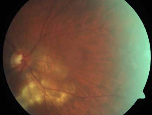 Serpiginouse Choroiditis (Chorioretinitis) - Acute Right Eye - Old Left Eye VA 20/25 OD , 20/50 OS - 1 Week After Intravitreal Kenalog OD
63-year-old woman has serpiginous choroiditis  1 week after intravitreal kenalog treatment
