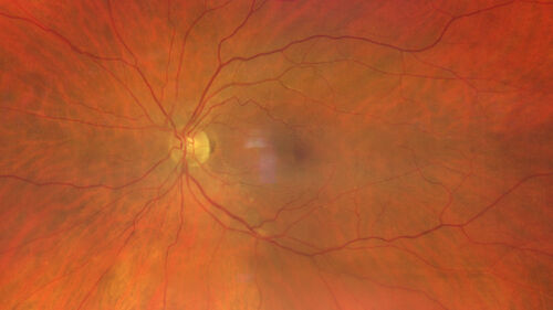 Serpiginous choroiditis in the right eye
68 year old female with spots in vision in the right eye for 2 months.  She has a history of MS.  The vision is 20/32 in both eyes.  She was treated with high dose steroids and transitioned to methotrexate and the right eye quieted  down.
